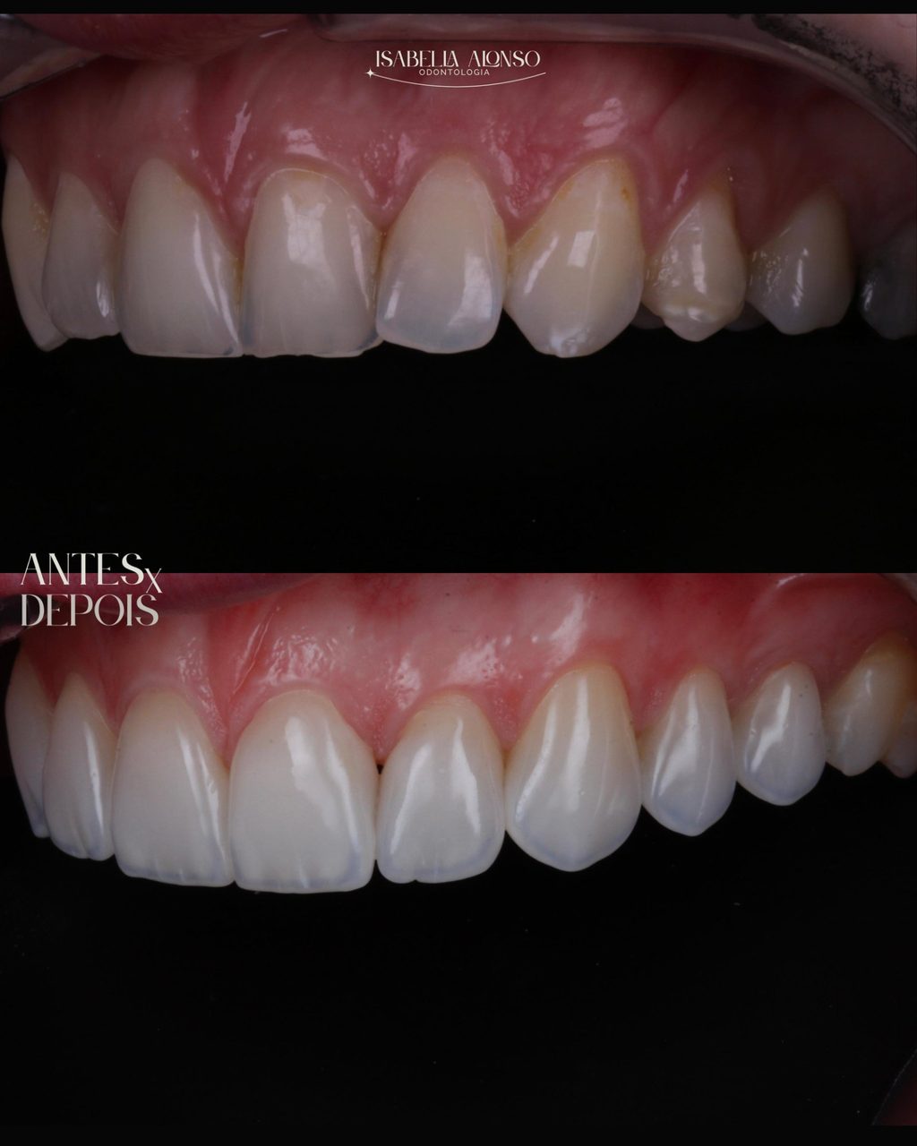 Resultado final do tratamento com facetas