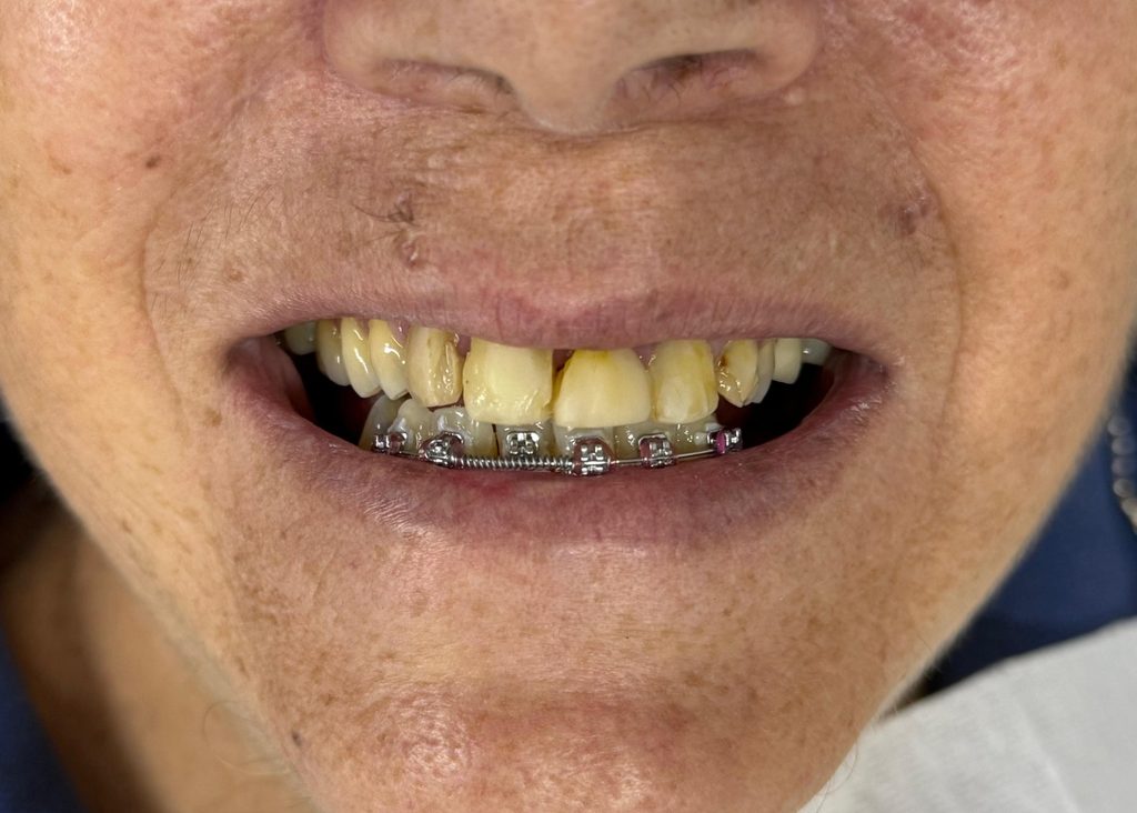 Reabilitação oral fase intermediária